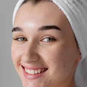 Home Remedies For Acne